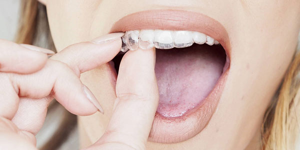 Invisalign Kosten - Herausnehmbare unsichtbare Zahnspange - Invisalign