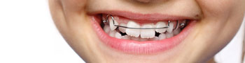 Herausnehmbare Zahnspangen für Kinder - Kieferorthopäde Dr Dörfer