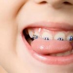 Feste Zahnspangen für Kinder - Dörfer Kieferorthopädie
